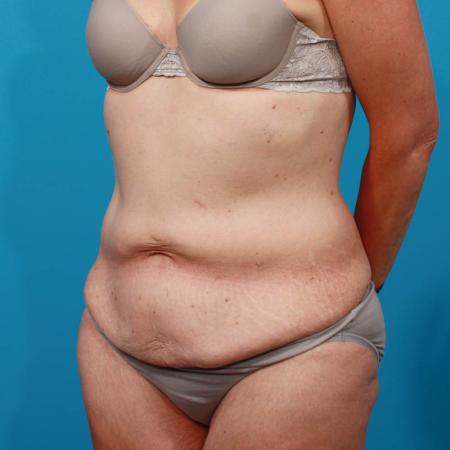 Before image 2 Case #103846 - Tummy Tuck