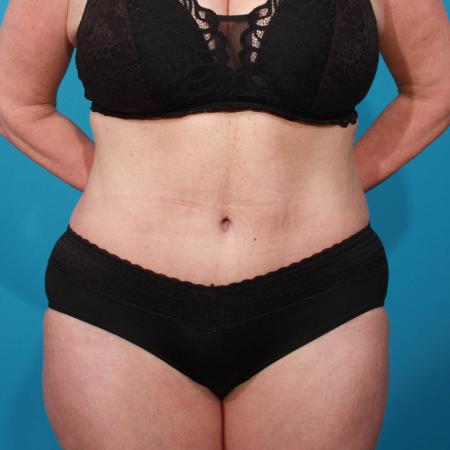 After image 1 Case #103906 - Tummy Tuck with SAL