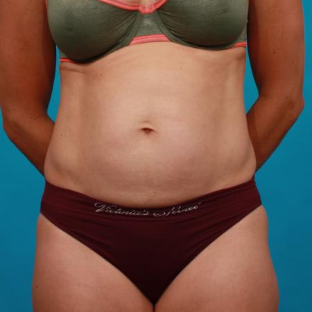 Before image 1 Case #104186 - Tummy Tuck