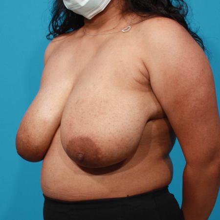 Before image 2 Case #103706 - Breast Reduction