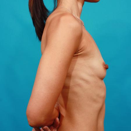 Before image 3 Case #104116 - Breast Augmentation