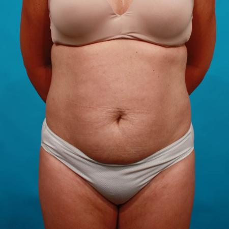 Before image 1 Case #103671 - Tummy Tuck