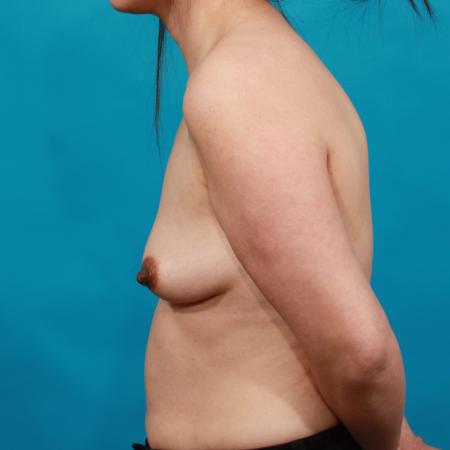 Before image 3 Case #103991 - BL / BA / Nipple Reduction