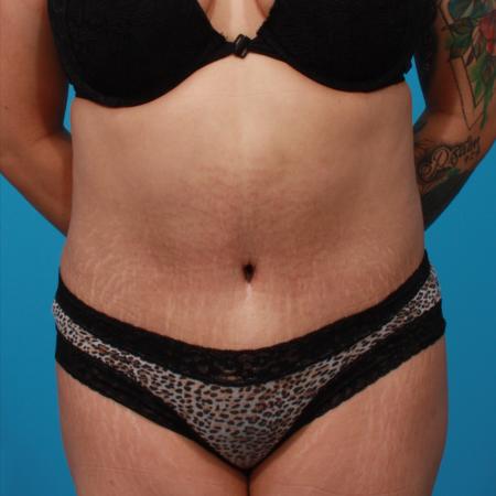 After image 1 Case #104356 - Tummy Tuck