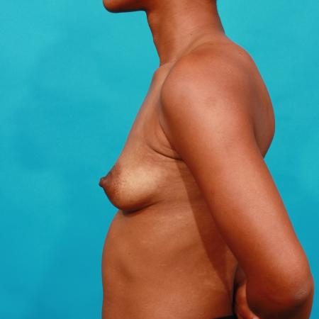 Before image 3 Case #104191 - Breast Augmentation
