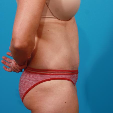 After image 3 Case #104186 - Tummy Tuck
