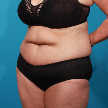 Before image 2 Case #103906 - Tummy Tuck with SAL