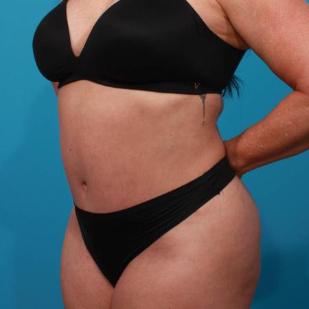 After image 2 Case #103926 - Tummy Tuck with SAL