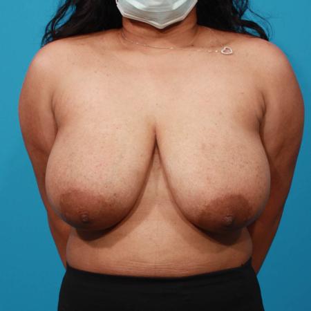 Before image 1 Case #103706 - Breast Reduction