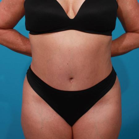 After image 1 Case #103926 - Tummy Tuck with SAL