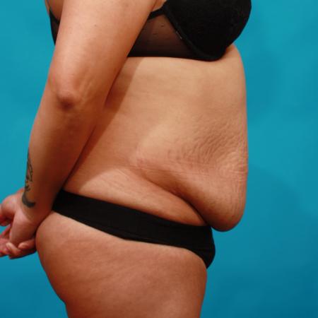 Before image 3 Case #104356 - Tummy Tuck