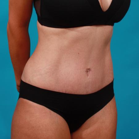 After image 2 Case #104071 - Tummy Tuck with SAL