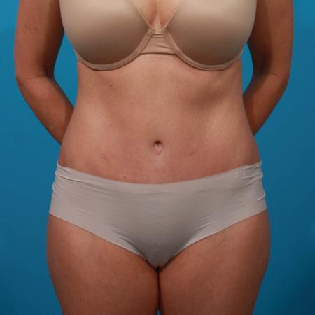 After image 1 Case #103816 - Tummy Tuck