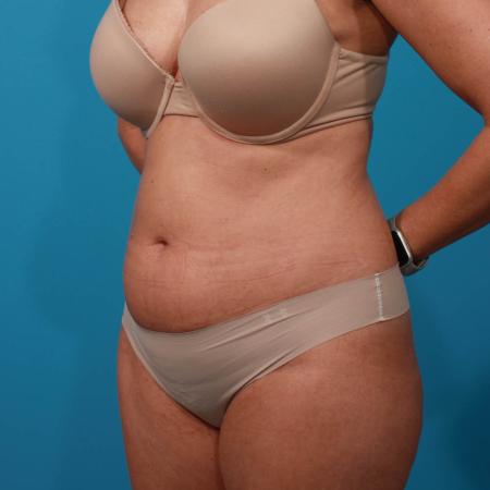 Before image 2 Case #103816 - Tummy Tuck