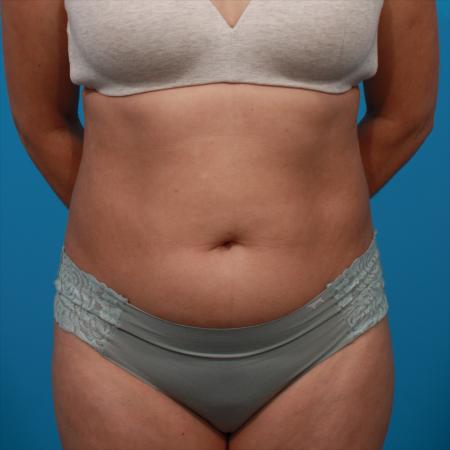 Before image 1 Case #104331 - Tummy Tuck