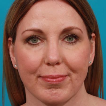 After image 1 Case #104251 - Chin Augmentation