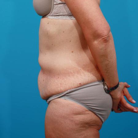 Before image 3 Case #103846 - Tummy Tuck