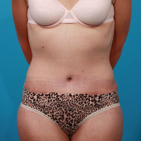 After image 1 Case #103846 - Tummy Tuck