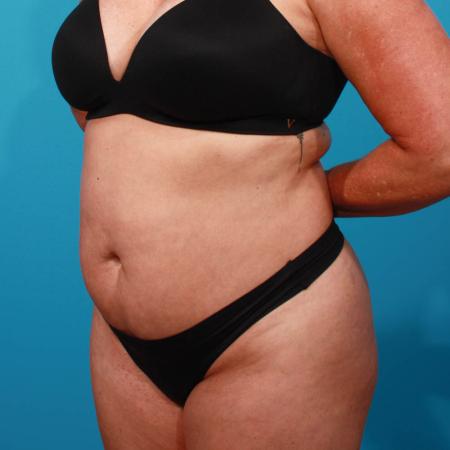 Before image 2 Case #103926 - Tummy Tuck with SAL