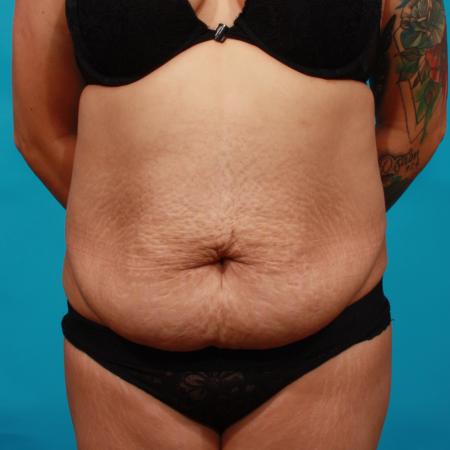 Before image 1 Case #104356 - Tummy Tuck