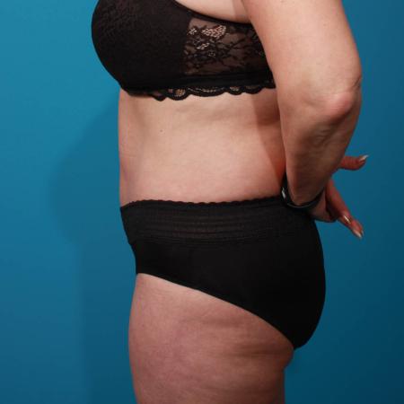 After image 3 Case #103906 - Tummy Tuck with SAL
