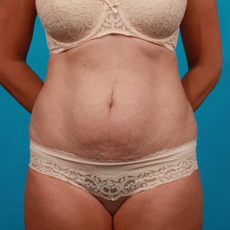 Before image 1 Case #104071 - Tummy Tuck with SAL