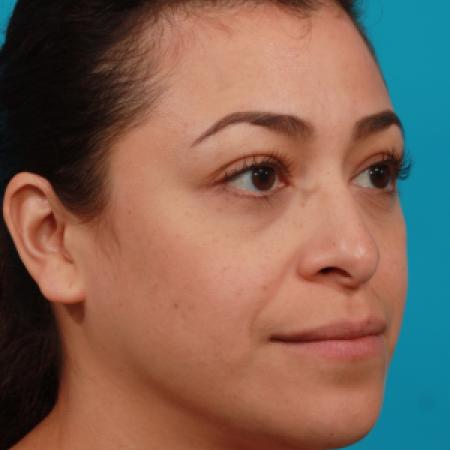 After image 2 Case #104336 - Blepharoplasty