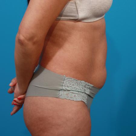 Before image 3 Case #104331 - Tummy Tuck