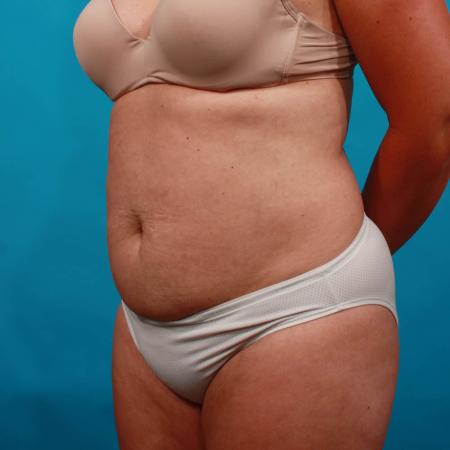 Before image 2 Case #103671 - Tummy Tuck