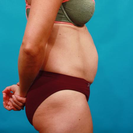 Before image 3 Case #104186 - Tummy Tuck