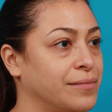 Before image 2 Case #104336 - Blepharoplasty