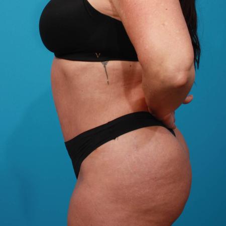 After image 3 Case #103926 - Tummy Tuck with SAL