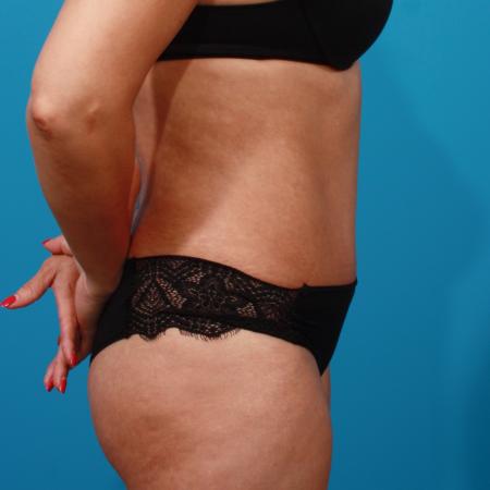 After image 3 Case #104331 - Tummy Tuck