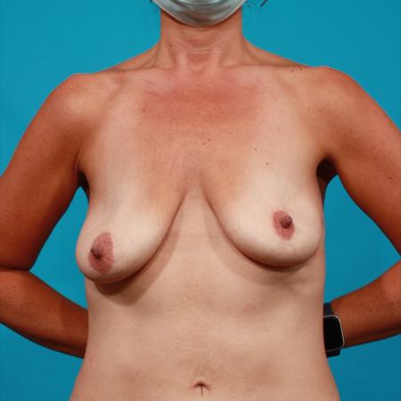 Before image 1 Case #104306 - Mastopexy
