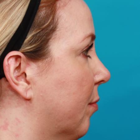 Before image 3 Case #104251 - Chin Augmentation