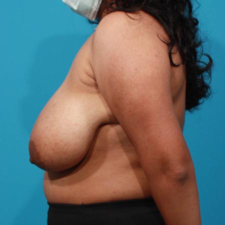Before image 3 Case #103706 - Breast Reduction