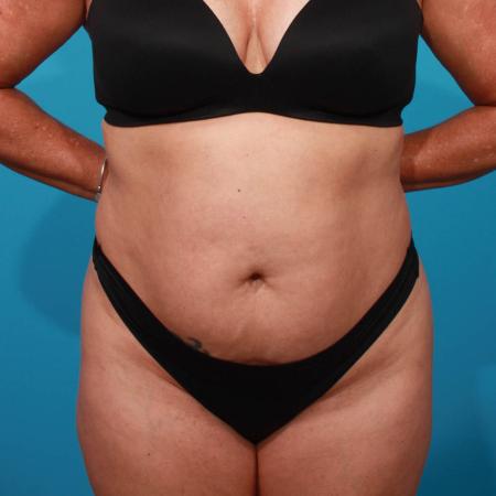Before image 1 Case #103926 - Tummy Tuck with SAL