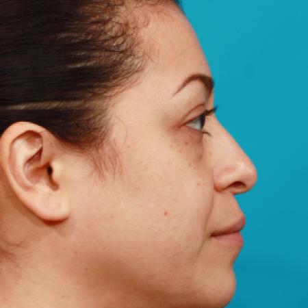 Before image 3 Case #104336 - Blepharoplasty