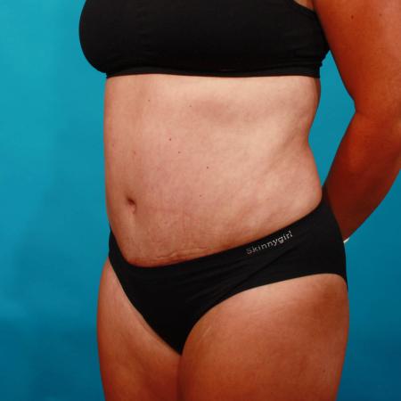 After image 2 Case #103671 - Tummy Tuck