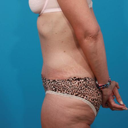 After image 3 Case #103846 - Tummy Tuck