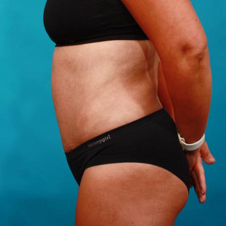 After image 3 Case #103671 - Tummy Tuck