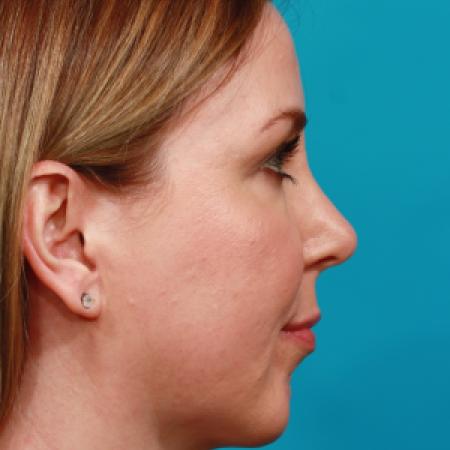 After image 3 Case #104251 - Chin Augmentation