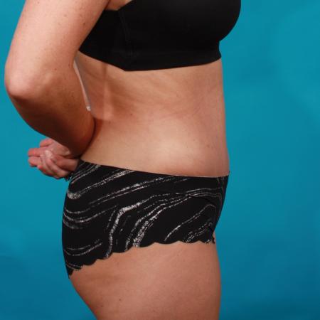 After image 3 Case #104206 - Tummy Tuck