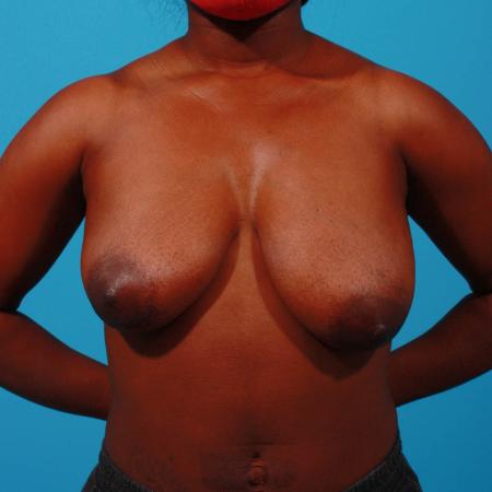 Before image 1 Case #103796 - Breast Lift