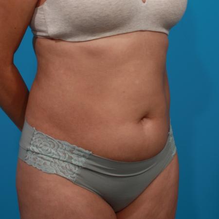 Before image 2 Case #104331 - Tummy Tuck