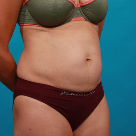 Before image 2 Case #104186 - Tummy Tuck