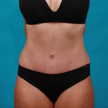 After image 1 Case #104071 - Tummy Tuck with SAL
