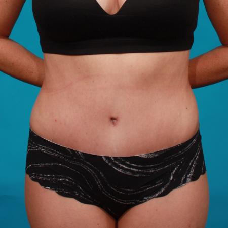 After image 1 Case #104206 - Tummy Tuck