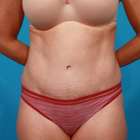 After image 1 Case #104186 - Tummy Tuck
