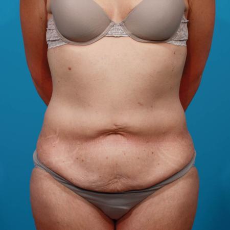Before image 1 Case #103846 - Tummy Tuck